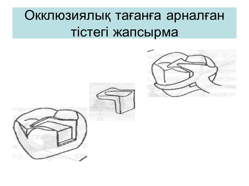 Окклюзиялық тағанға арналған тістегі жапсырма